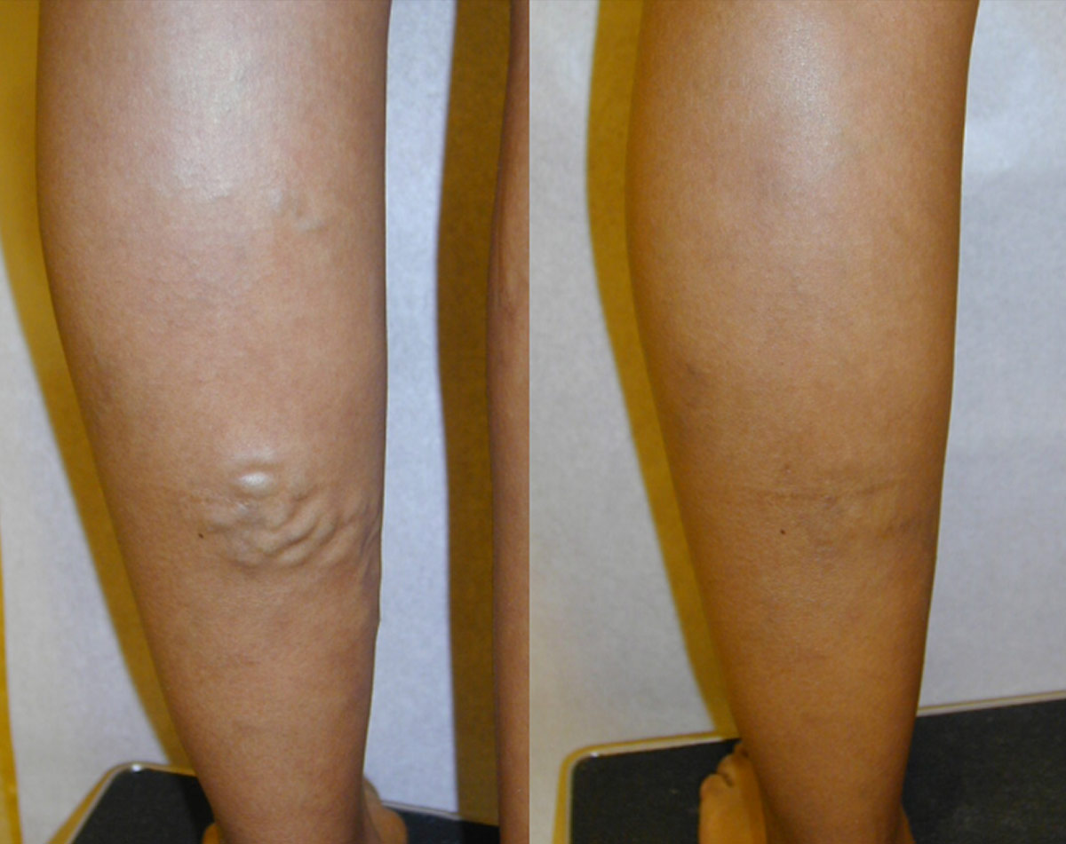 Before and after vein treatment, Miami Vein Institute case 10