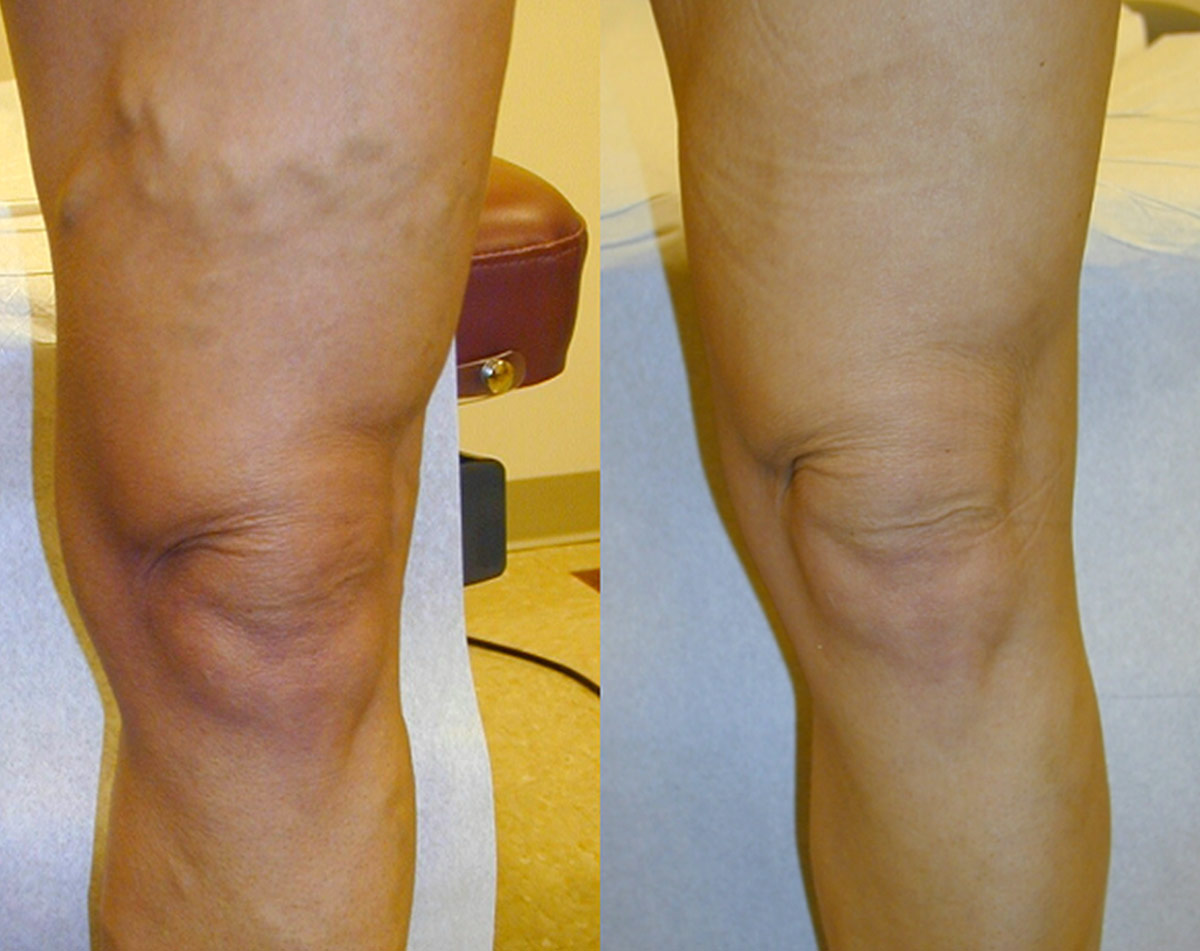 Before and after vein treatment, Miami Vein Institute case 9