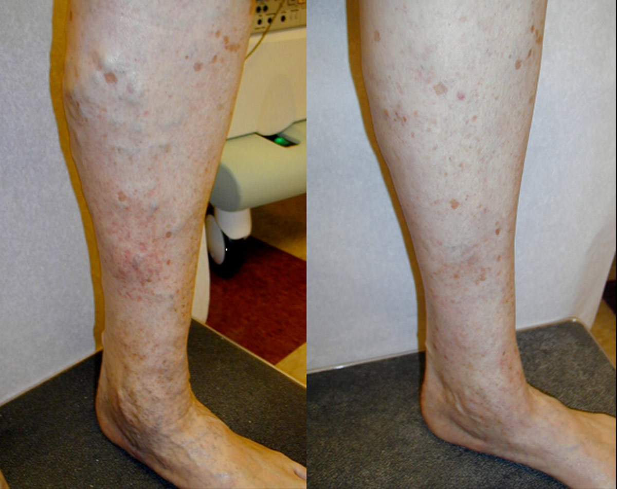 Before and after vein treatment, Miami Vein Institute case 6