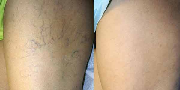 Spider vein treatment before and after, Miami Vein Institute case 23