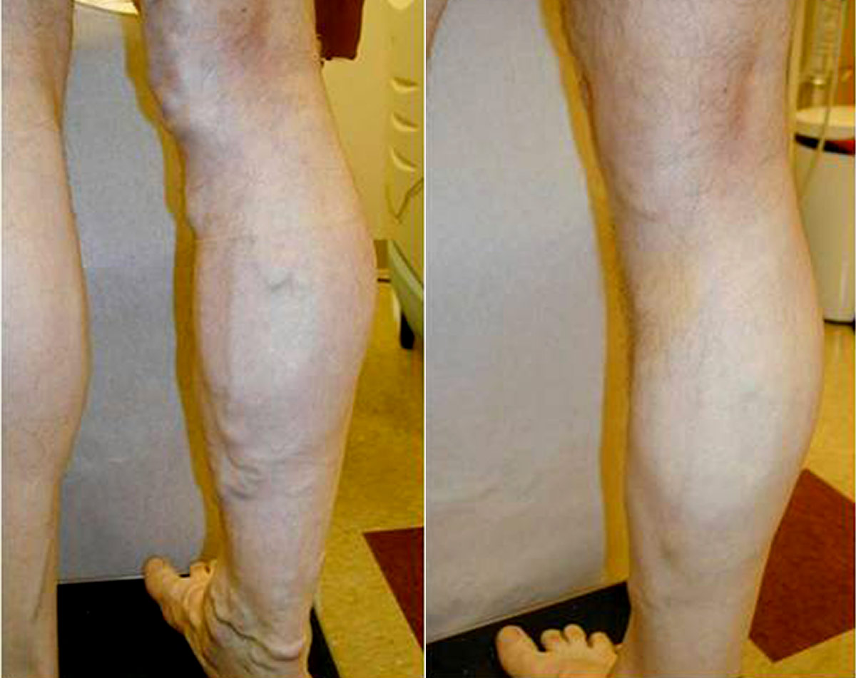 Before and after vein treatment, Miami Vein Institute case 11
