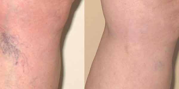 Spider vein treatment before and after, Miami Vein Institute case 22