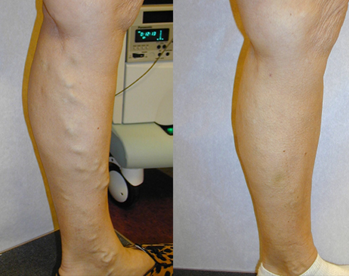 Before and after vein treatment, Miami Vein Institute case 12