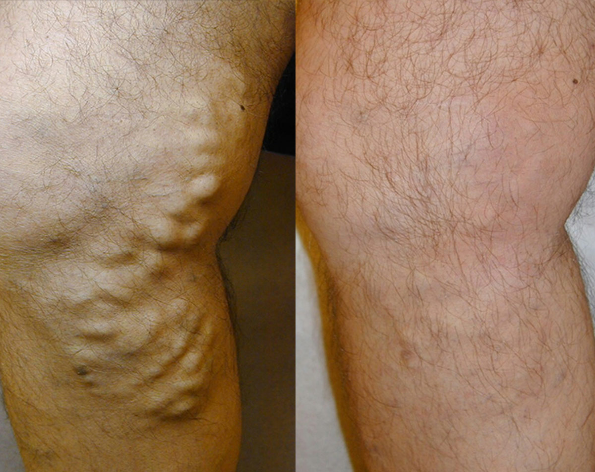 Before and after vein treatment, Miami Vein Institute case 19