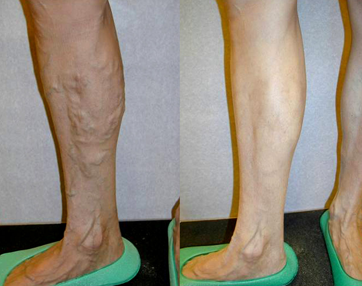 Before and after vein treatment, Miami Vein Institute case 13